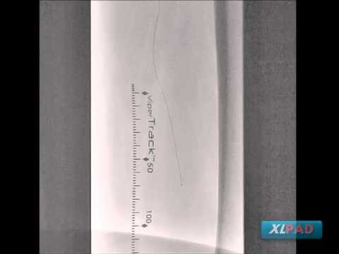 Mid SFA CTO Treated with Cross Boss #1