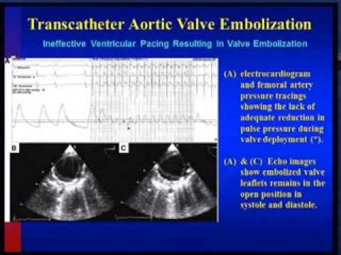 Transcatheter Aortic Valve Replacement: Recognition and Management of Procedural Complications