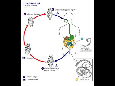 gyermekek trichocephalosis tünetei