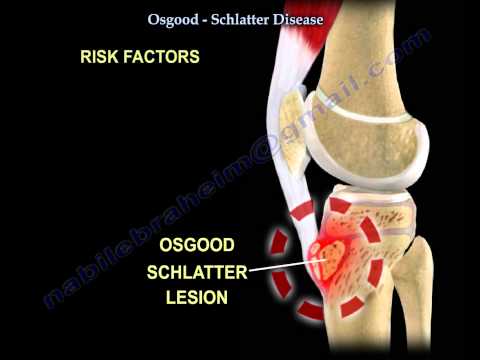 A térd schlatter-betegsége Mi az a Osgood-Schlatter-betegség?