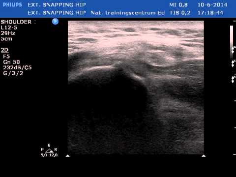 External snapping hip ultrasound