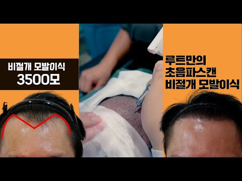 모발이식 비절개3500모 M자모발이식  밀도보강 루트만의 초음파스캔비절개모발이식 전 후를 소개합니다.