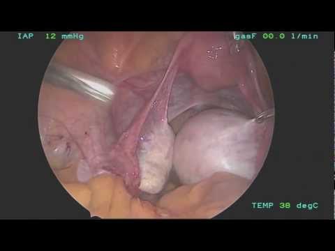 Ooforoplastia por video (cisto dermoide) / Video oophoroplasty (dermoid  cyst) 