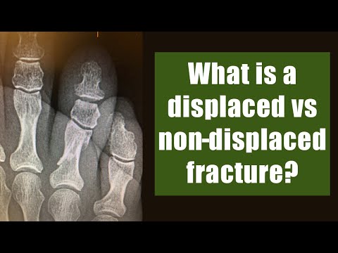 What is a displaced vs non-displaced fracture