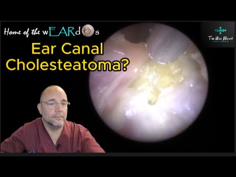 Ear Canal Cholesteatoma? 180 #ear #earwax #earwaxremoval #earcleaning  #asmr #asmrearwax #satisfying