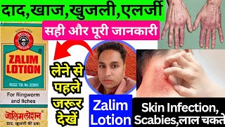 zalim lotion | zalim lotion uses in hindi | zalim lotion for fungal infection | zalim lotion ad |