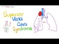 Superior Vena Cava SVC Syndrome Pancoast Tumor Pathology Oncology 5 Minute Review