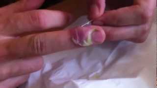Draining an Infected finger (Paronychia)
