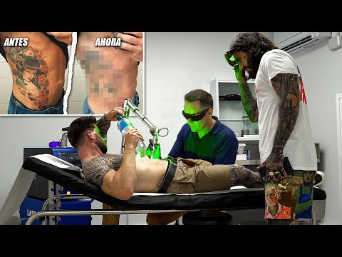 SERGIO FERAY se BORRA un TATUAJE con LÁSER y EXPLICAMOS CÓMO FUNCIONA 🧨