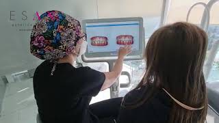 Invisalign; Las 6 etapas del tratamiento