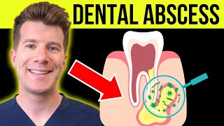 Doctor explains DENTAL ABSCESS (tooth abscess) | Causes, symptoms & treatment