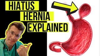 Everything you need to know about a HIATUS HERNIA | Causes, symptoms, diagnosis & treatment