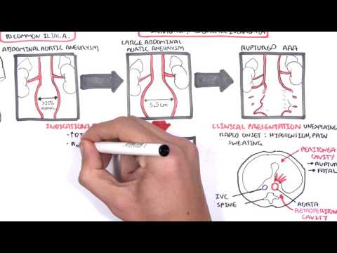 Aorta aneurysma és magas vérnyomás - Aorta aneurysma: tünetek és kezelés