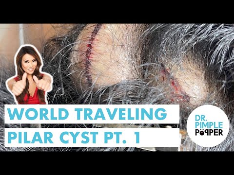 World Traveling Pilar Cyst Part 1