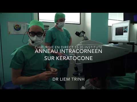 Anneau intracornéen pour kératocône chirurgie en direct 15-20 Institute (Dr Trinh)