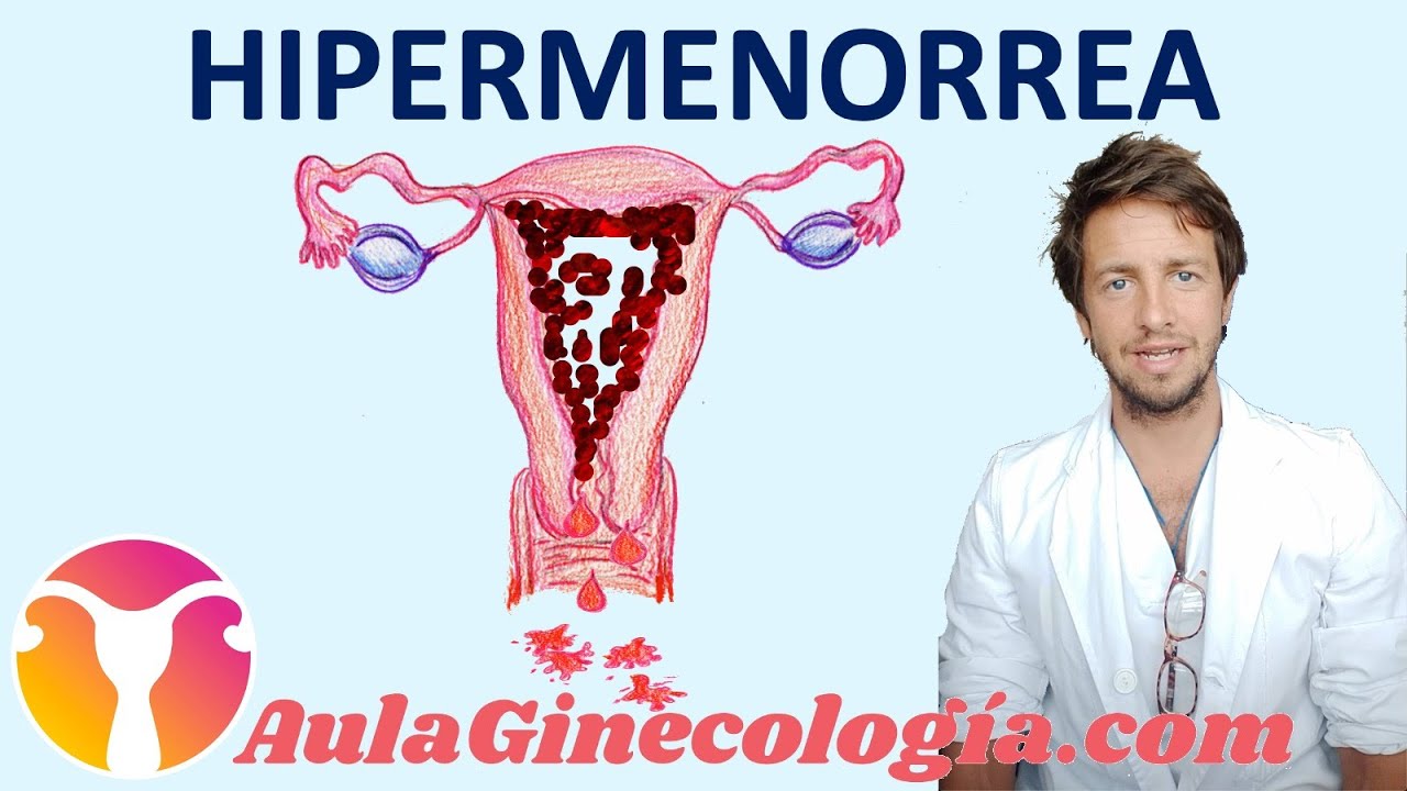 Watch HIPERMENORREA (sangrado o regla abundante). Causas y tratamiento - Ginecología y Obstetricia Now HIPERMENORREA (sangrado o regla abundante). Causas y tratamiento - Ginecología y Obstetricia