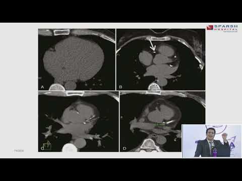 CT Coronary Angiography : Where Does It Fit in Contemporary Practice?  | Dr. Ranjan Shetty