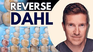 Reverse Dahl Technique for Localised Posterior Tooth Surface Loss - PDP235