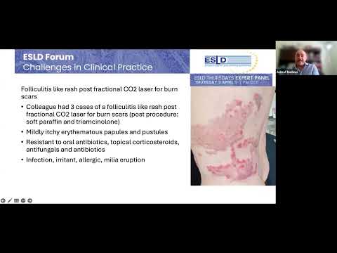 ESLD Thursday - April 2025 - Challenges in clinical practice