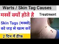 Permanent Cure For Skin Tags Why Do Warts Occur Skin Tags Permanent Cure