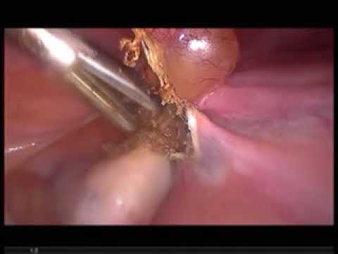 laparoscopic hysterectomy in patient with previous caesarian section