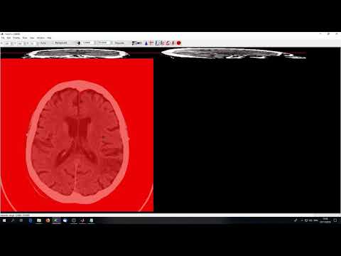 Methods in Neuropsychology Tübingen - Tutorial 1 Lesion Delineation and Normalisation