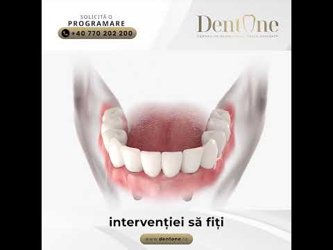 De ce proteza mobilă nu este o soluție pe termen lung