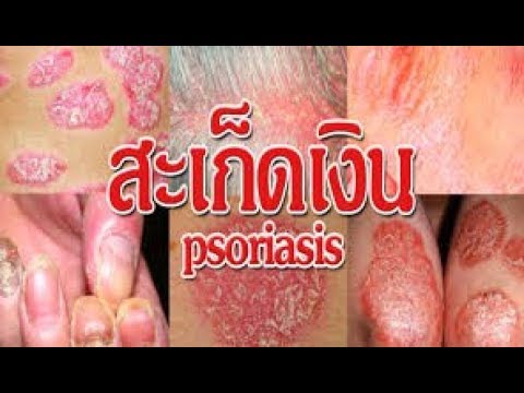 ลดอาการคัน neurodermatitis Tselestoderm รักษากลาก