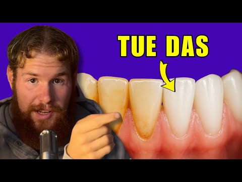 Die #1 STÄRKSTE Lösung für Zahn Plaques (Weißzahn Methode)