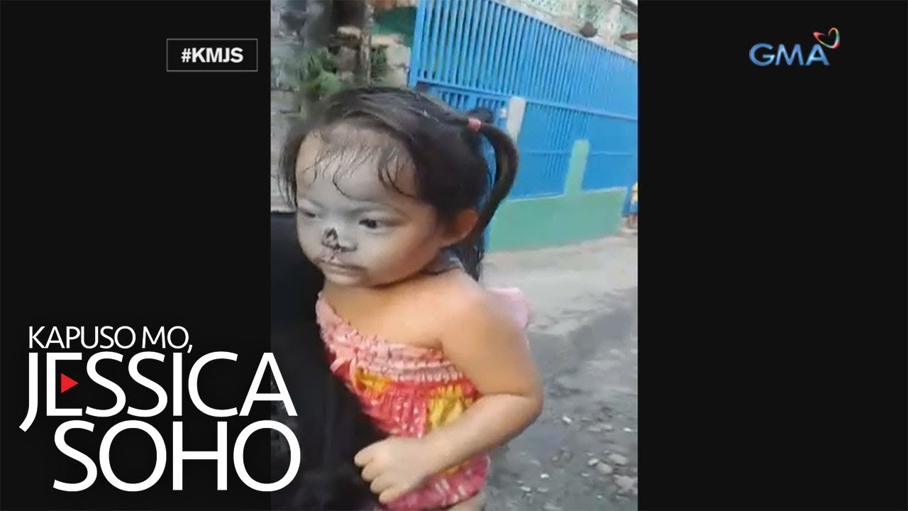 Putar video Kapuso Mo, Jessica Soho: Bata, kinagat ng aso ang ilong! sekarang Kapuso Mo, Jessica Soho: Bata, kinagat ng aso ang ilong!