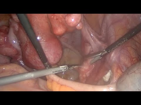 Parasitic Leiomyoma