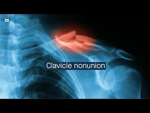 Clavicle nonunion: management and considerations
