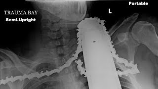 Horrific chainsaw accident: Man gets blade stuck in neck and survives