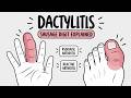 Dactylitis (Sausage Digit) Explained Causes, Symptoms & Associations