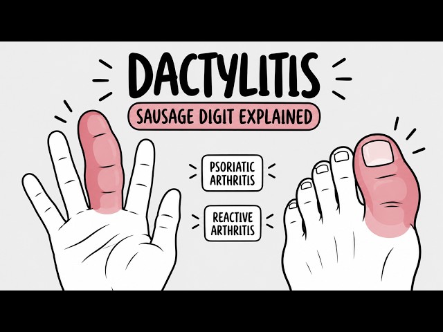 Dactylitis (Sausage Digit) Explained Causes, Symptoms & Associations