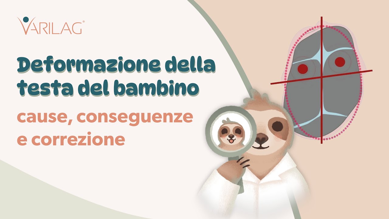 Deformazione della testa del bambino - informazioni importanti su cause, conseguenze e correzione