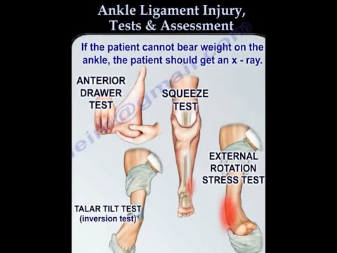 Assessing and Treating Ankle Ligament Injuries: From Evaluation to Recovery