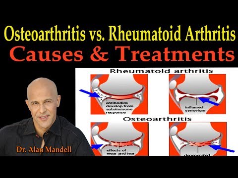 Arthritis orvoslás