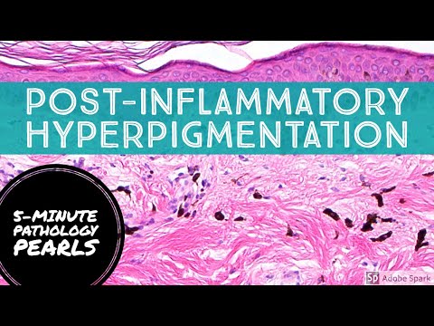Post-Inflammatory Hyperpigmentation (Pigment Incontinence): 5-Minute Pathology Pearls