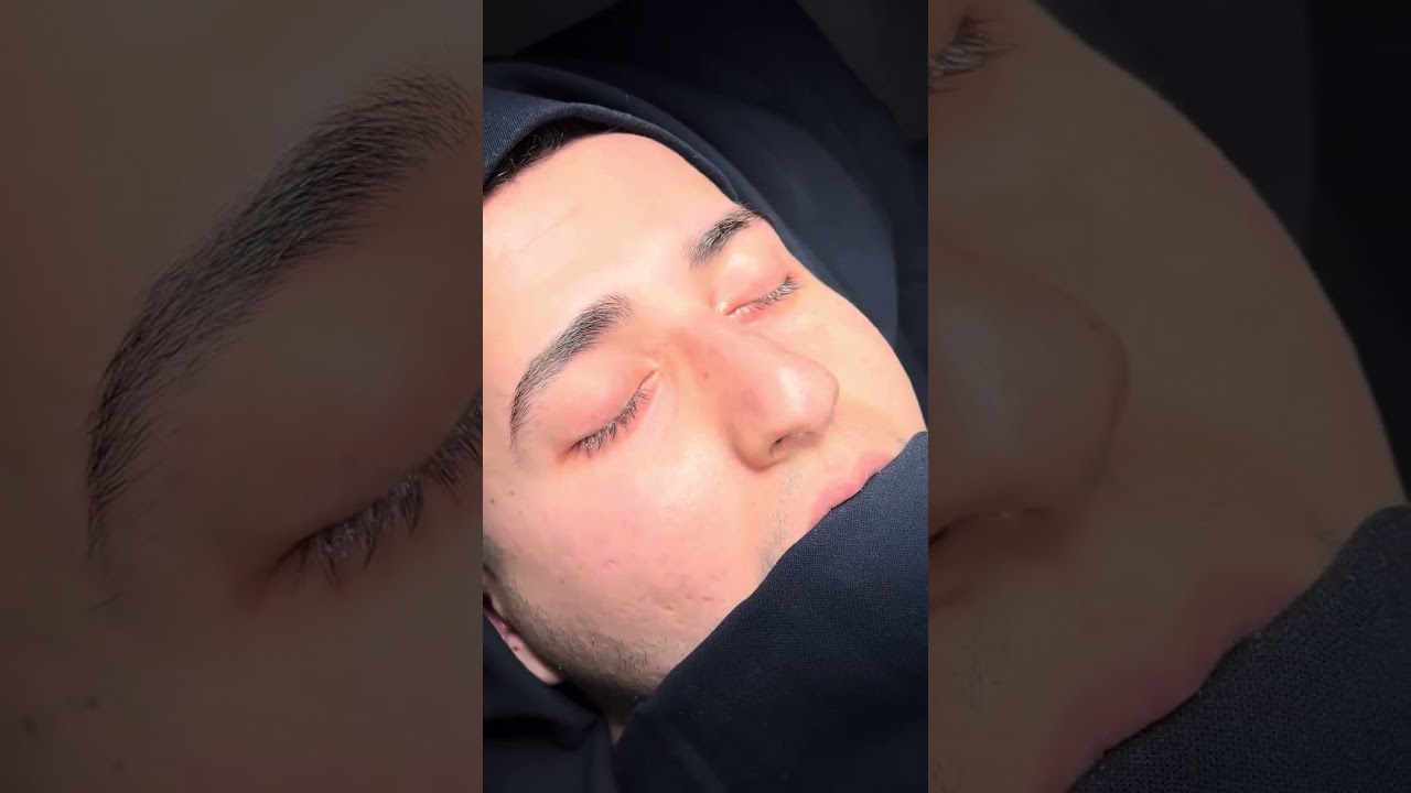 Revizyon Rinoplasti - Video 4