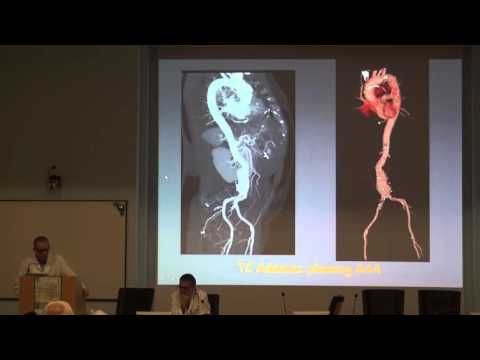 Candele per adenoma della prostata negli uomini Operazione di rimozione di BPH nel prezzo Kharkov
