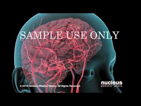Accidente cerebrovascular hemorrágico