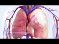 DVT Can Lead To Pulmonary Embolism PE