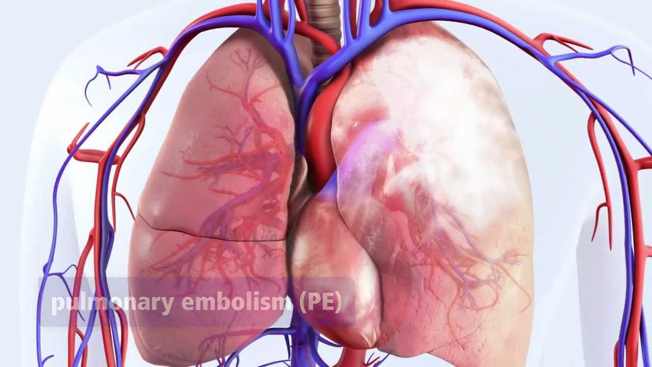 DVT can lead to pulmonary embolism (PE)
