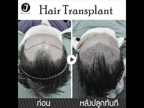 รีวิวปลูกผมเทคนิค FUE | ผู้ชาย แพทเทริน์ M | เลิกล้านไม่ต้องลุ้น