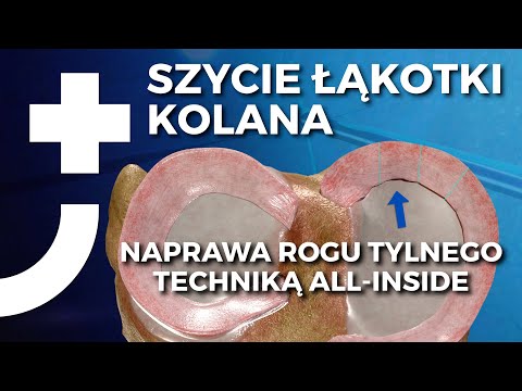 Szycie łąkotki kolana - naprawa rogu tylnego techniką all-inside - Nowa Ortopedia