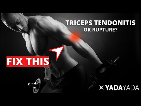 Triceps Tendonitis or Rupture?  Signs, symptoms, and treatment options. Elbow pain!
