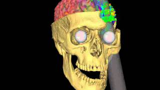 Phineas Gage's brain