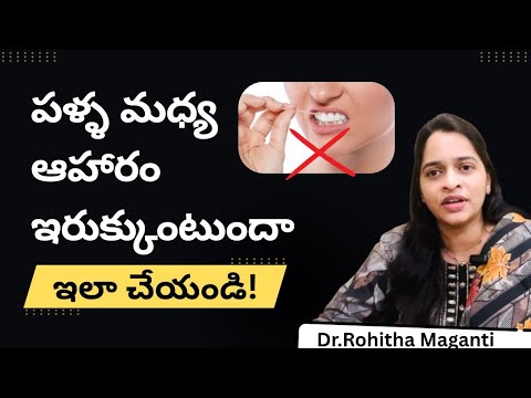 Why Food Gets Stuck Between Teeth | Causes & Best Treatment | #drrohithamaganti
