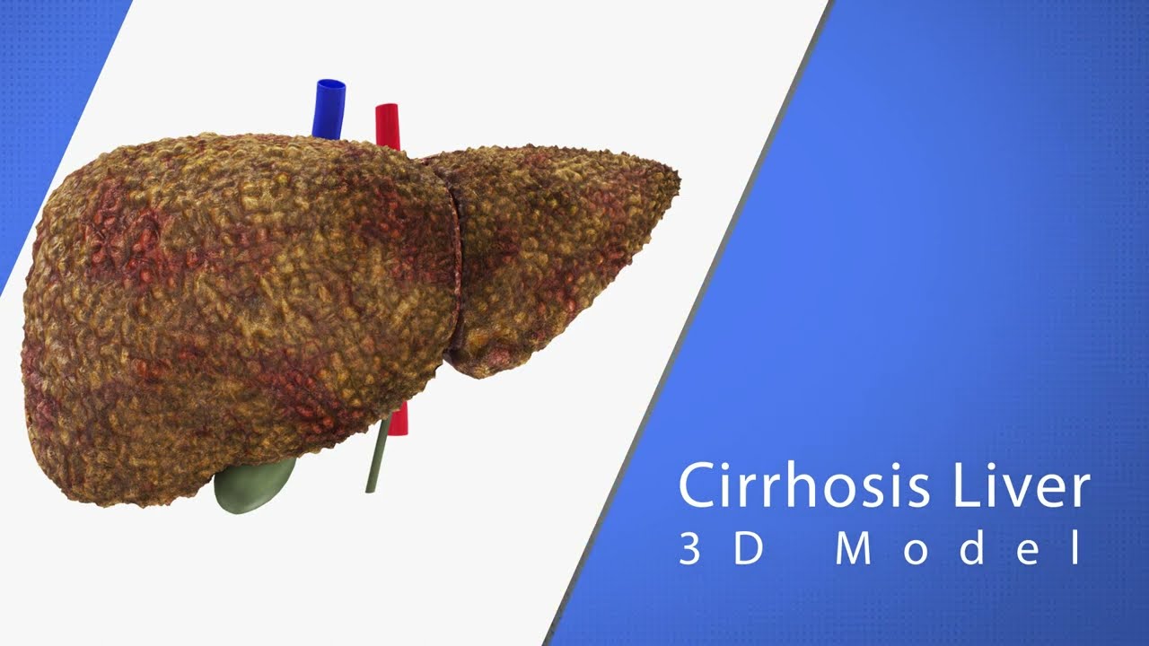 Cirrhosis Liver Disease 3D Model